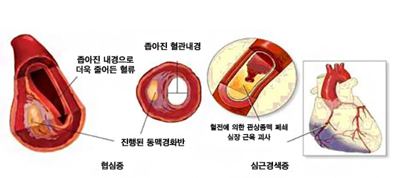 협심증, 심근경색증 사진