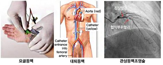 요골동맥, 대퇴동맥, 관상동맥조영술 사진