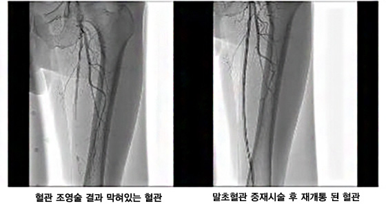 혈관 조영술 결과 막혀있는 혈관, 말초혈관 중재시술 후 재개동 된 혈관