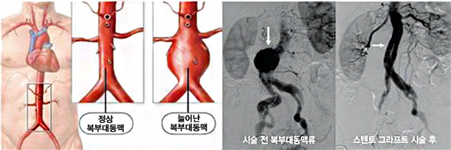 정상 복부대동맥, 늘어난 복부대동맥, 시술 전 복부대동맥류, 스텐트 그라프트 시술 후