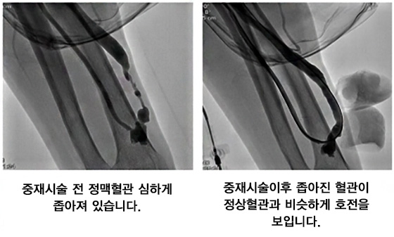 중재시술 전 정맥혈관이 심하게 좁아져 있습니다., 중재시술이후 좁아진 혈관이 정상혈관과 비슷하게 호전을 보입니다.