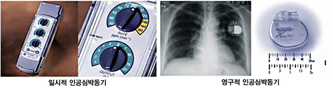 일시적 인공심박동기, 영구적 인공심박동기