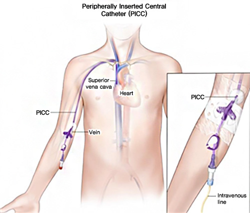 Peripherally Inserted Central Catheter(PICC) 사진