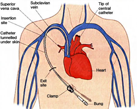 중심 정맥관 사진