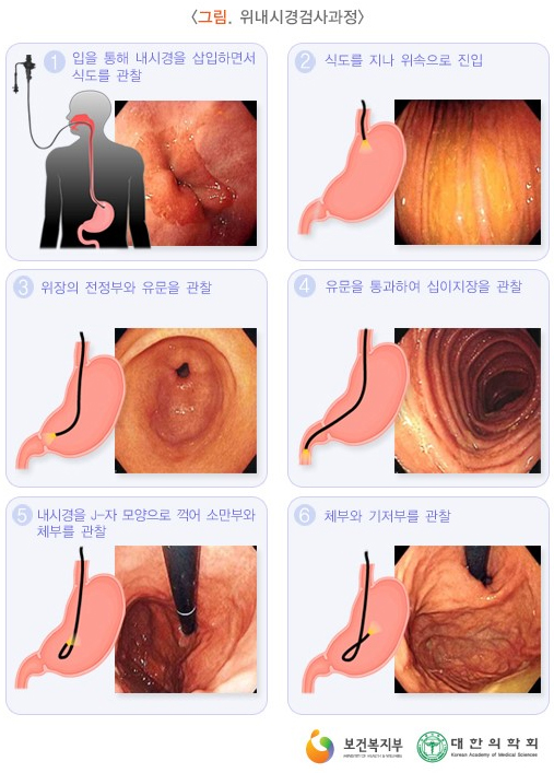 위내시경검사과정