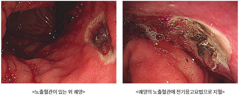 노출혈관이 있는 위 궤양, 궤양의 노출혈관에 전기응고요법으로 지혈