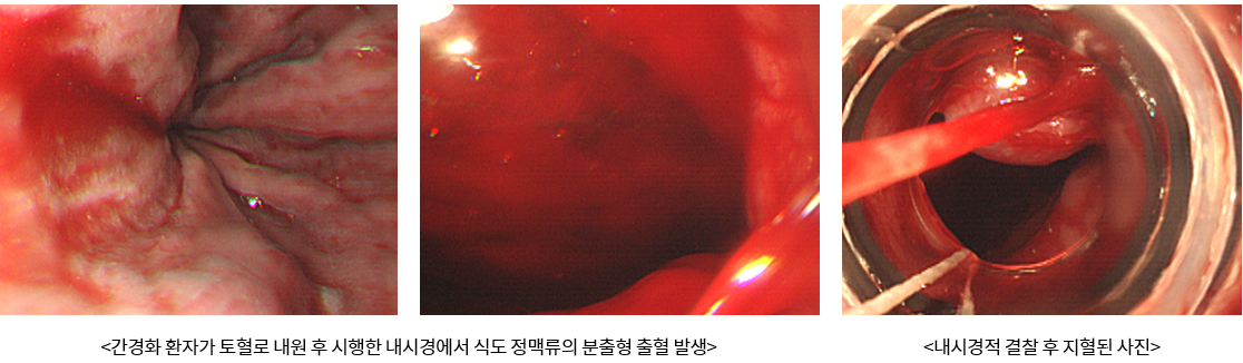 간경화 환자가 토혈로 내원 후 시행한 내시경에서 식도 정맥류의 분출형 출혈 발생, 내시경적 결찰 후 지혈된 사진