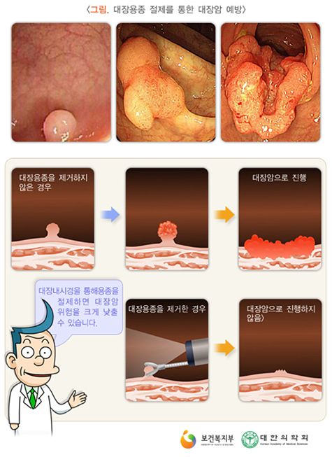 대장용종 절제를 통한 대장암 예방