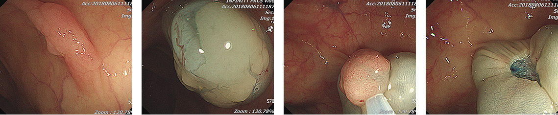 대장용종 절제술의 과정
