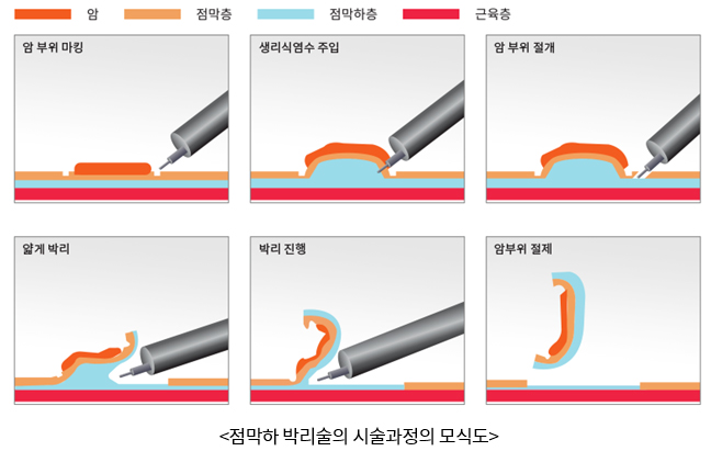 점막하 박리술의 시술과정의 모식도