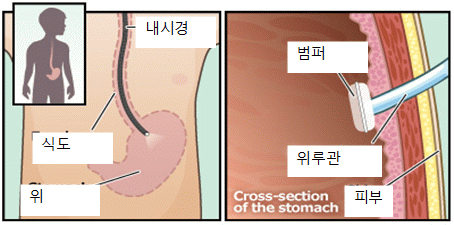 경피 내시경적 위루술