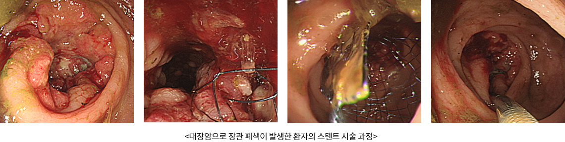 대장암으로 장관 폐색이 발생한 환자의 스텐트 시술 과정