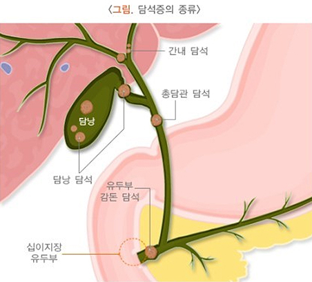 담석증의 종류