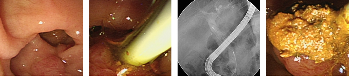 내시경적 역행적 담췌관조영술 (ERCP)과 담석 제거술 과정